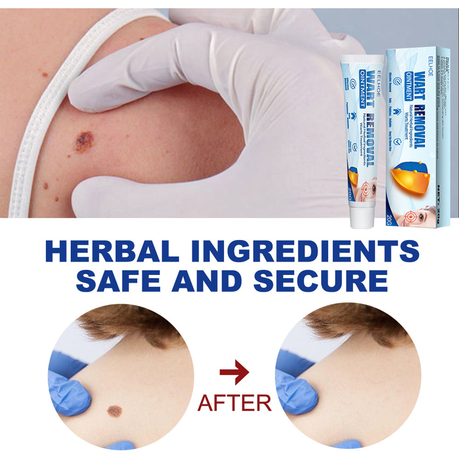 "EELHOE Wart Blemish Removal Cream Borneol Honeysuckle – AdriaPulse"